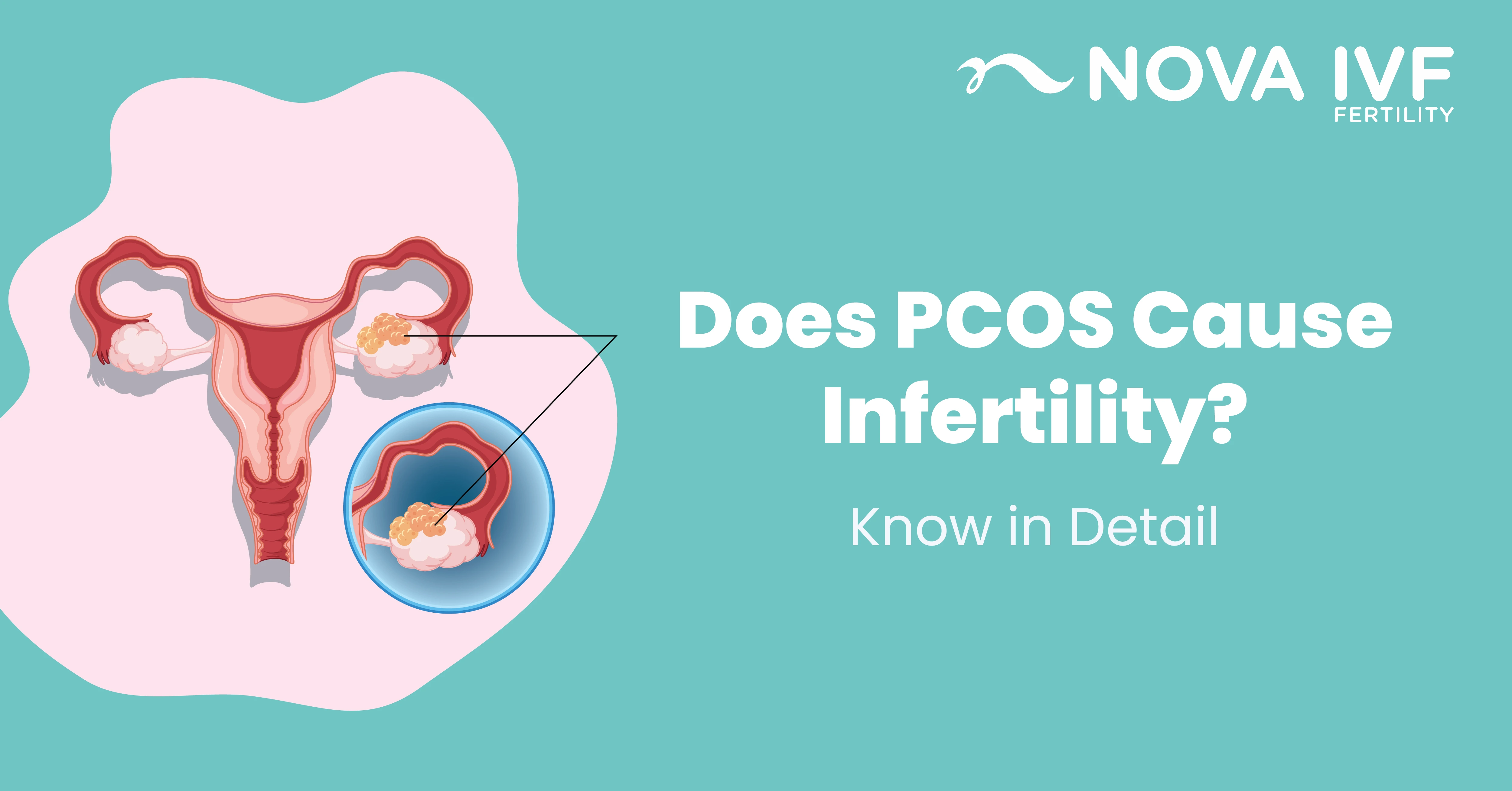 does-pcos-cause-infertility-know-in-detail